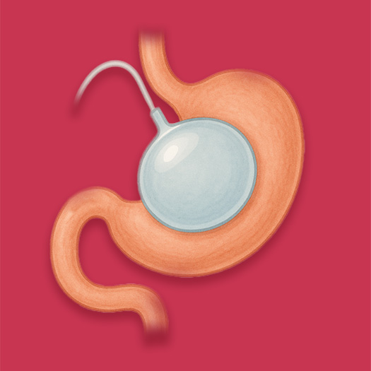 Ballon gastrique en Turquie