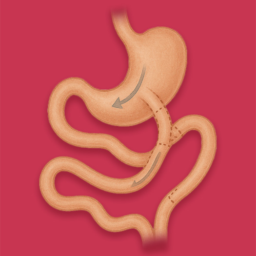 Bipartition du Transit Gastrique en Turquie