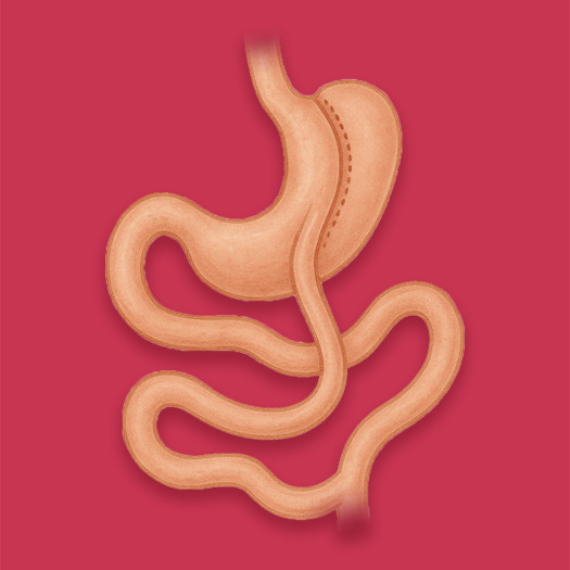 Bypass gastrique en Turquie