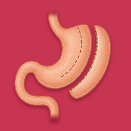 Sleeve Gastrectomie en Turquie